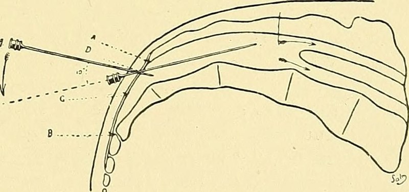 File:Caudal Block.jpg