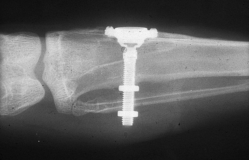 Файл:Branemark's initial radiograph.jpg