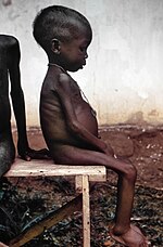 Niña con la enfermedad de Kwashiorkor