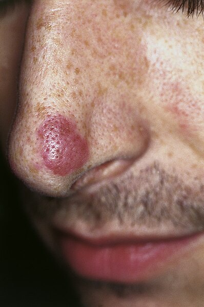 File:Facial eosinophilic granuloma.jpg