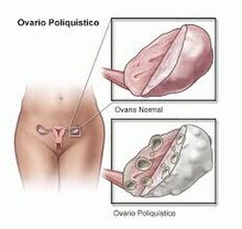 OVARIO POLIQUISTICO