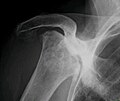 Radiografía de una osteonecrosis total de la cabeza del húmero derecho. Mujer de 81 años de edad con diabetes de larga evolución.