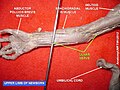 Ulnar nerve