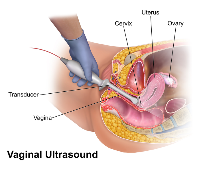 File:Vaginal Ultrasound.png