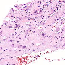 Epithelioid hemangioendothelioma.jpg