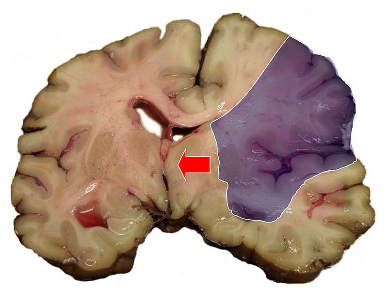 Файл:MCA-Stroke-Brain-Humn-2A.jpg