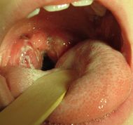 A set of large tonsils in the back of the throat covered in white exudate.