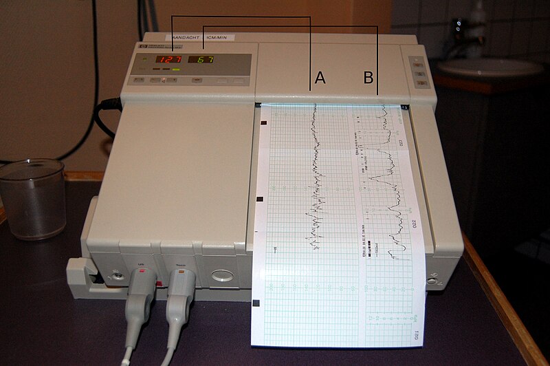 File:Cardiotocography diagram.jpg