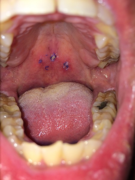 File:Soft palate stent.jpg