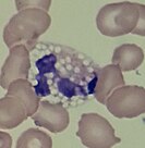 A neutrophil displaying toxic vacuolation