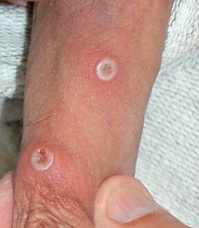 File:Monkeypox lesions.jpg