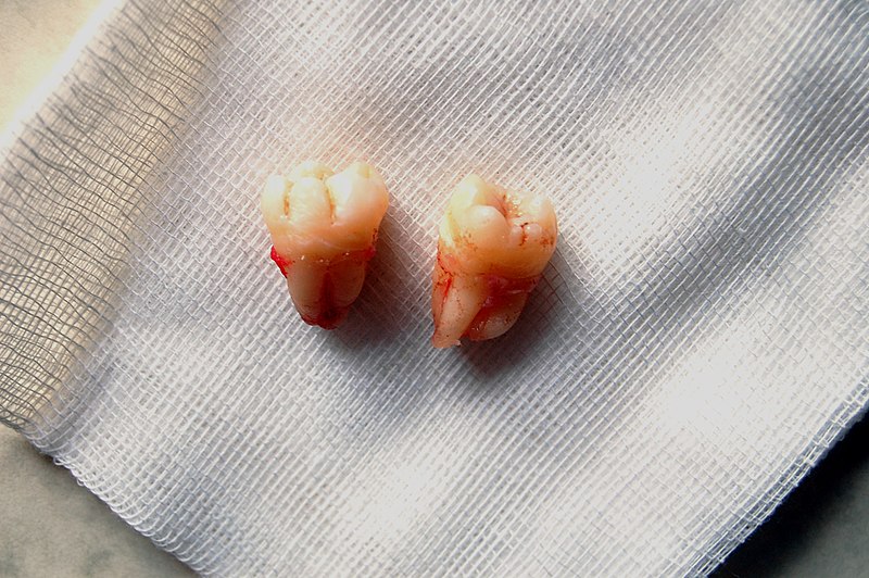 File:Wisdom teeth 2.jpg