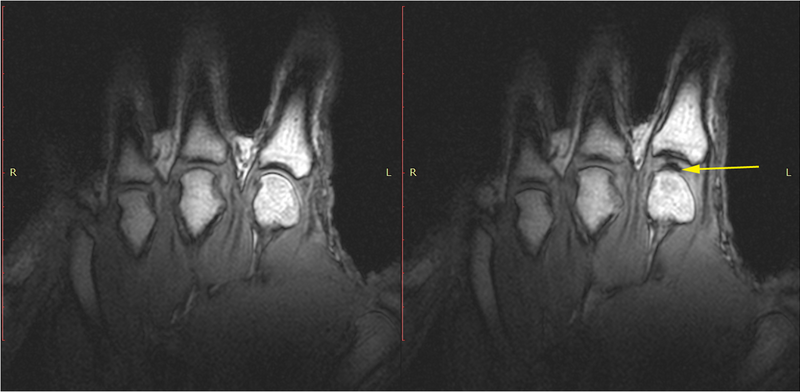 File:Visualization of Joint Cavitation.png