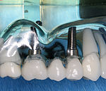 Implant retained fixed partial denture (FPD)