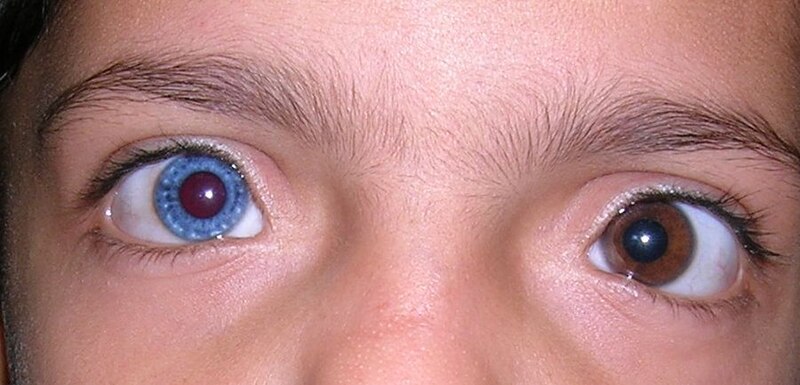 File:Heterochromia Iridis.jpg