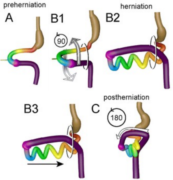 File:Intestinal rotation and herniation.png