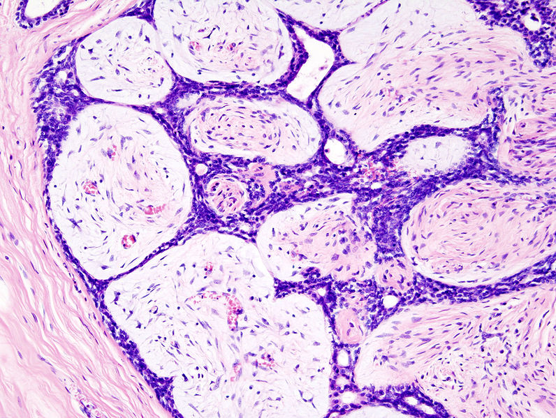 File:Breast fibradenoma (1).jpg