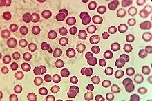 Microscopic view of Plasmodium in Erythrocytes