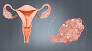 Thumbnail for Polycystic ovary syndrome