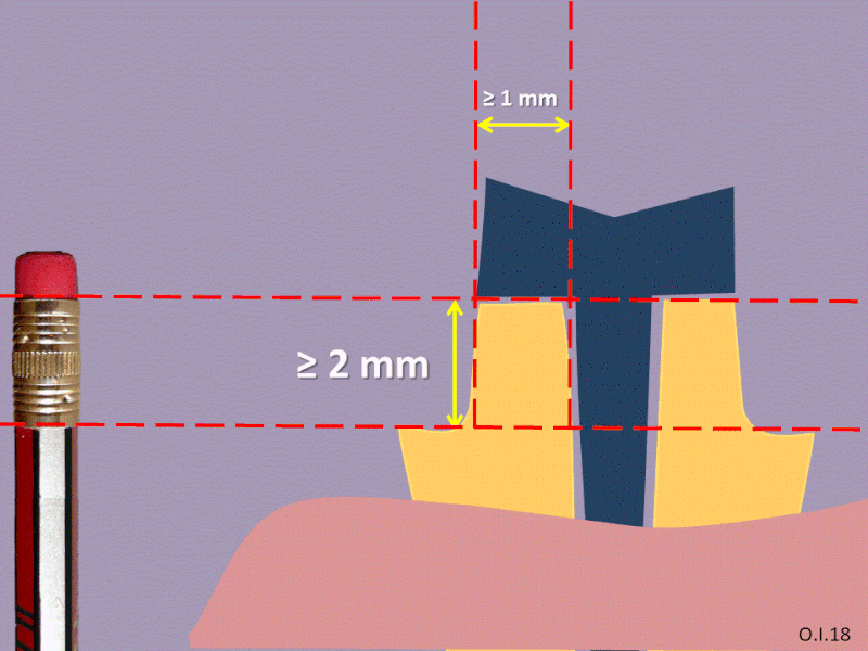 File:FerruleEffectDentistry.gif