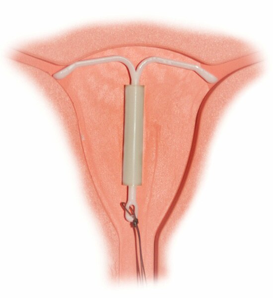 File:Mirena IntraUterine System.jpg