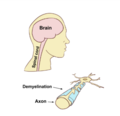 Thumbnail for CNS demyelinating autoimmune diseases