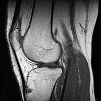 A knee examined via magnetic resonance imaging.