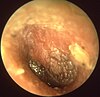 Acute otitis media