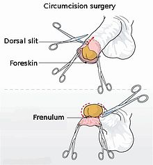 Circumcision illustration.jpg