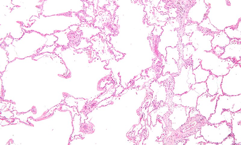 File:Emphysema low mag.jpg