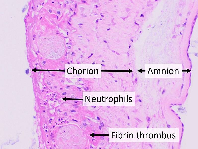 File:Histopathology of chorioamnionitis.jpg