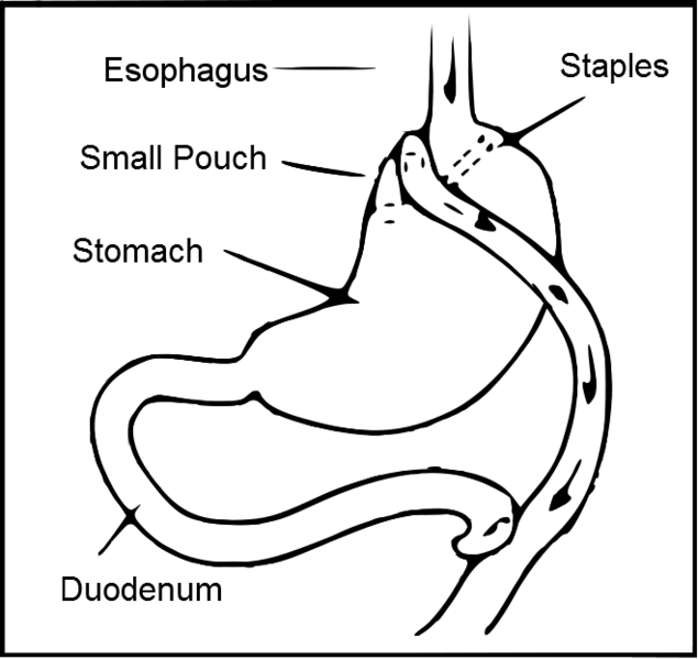 File:Roux-en-Y gastric bypass.png