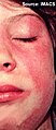 Malar and facial erythema. Acute onset of confluent macular erythema in a periorbital and malar distribution with extension to the chin in a girl with juvenile dermatomyositis. Note the perioral sparing.