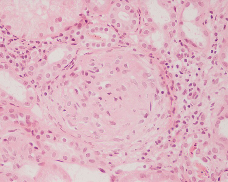 Archivo:Crescentic glomerulonephritis HE stain.JPEG