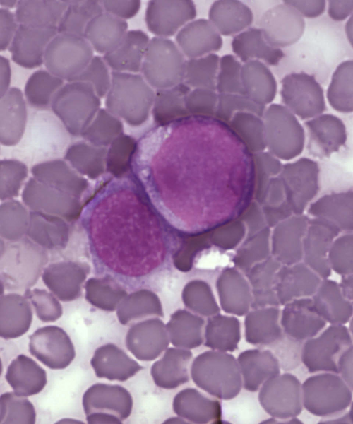 Archivo:Leukemia cells.png