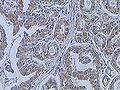 Breast cancer (Infiltrating ductal carcinoma of the breast) assayed with anti HER-2 (ErbB2) antibody