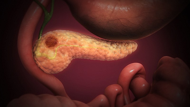 File:Pancreatic Cancer.jpg