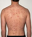 The back of a 30-year-old male, taken on day 5 of the rash