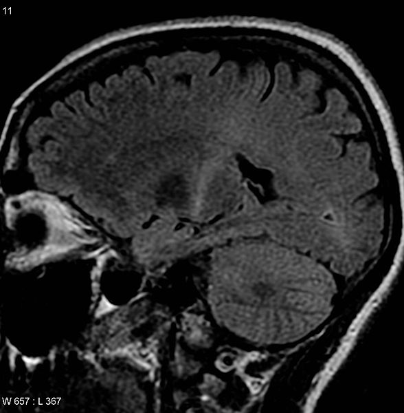 File:ALS Coronal.jpg