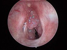 Papilomatosis Laríngea