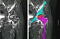 Resonancia magnética nuclear de una osteonecrosis de la cabeza femoral izquierda. Hombre de 45 años de edad con SIDA.