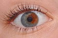 Sectoral heterochromia: a blue iris with a brown section.