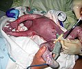 A newborn at 45 seconds, with umbilical cord clamped.