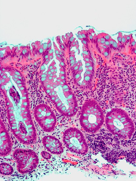 File:Hyperplastic polyp1.jpg