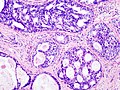 Histopathologic image from ductal cell carcinoma in situ (DCIS) of breast. Hematoxylin-eosin stain.