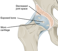 Annotated illustration of hip joint with osteoarthritis