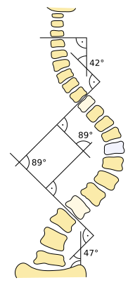 Файл:Scoliosis cobb.svg