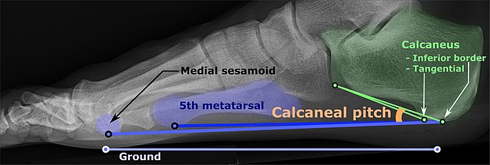 Weight-bearing lateral X-ray showing the measurement of calcaneal pitch, which is an angle of the calcaneus and the inferior aspect of the foot, with different sources giving different reference points.[18] Calcaneal pitch is increased in pes cavus, with cutoffs ranging from 20° to 32°.[17]