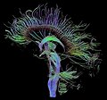 Sagittal fibers visualised using Diffusion Tensor Imaging technique