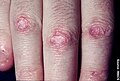 Gottron's papules with telangiectasia. Gottron's papules with prominent atrophy, porcelain white scarring, and telangiectasia.